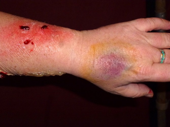 1st degree burns and bruises...