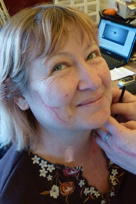 This is my friend Carol. It's been a while since I cut her face, but she's healing up nicely now.